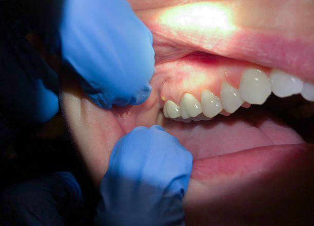 Best Broken or Cracked Tooth Emergency Dentist in North Patchogue, NY